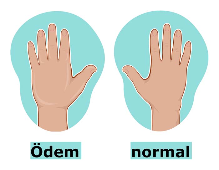 Gegenüberstellung von linker und rechter Hand, linke Hand mit Lymphödem ist deutlich angeschwollen im Vergleich zur rechten Hand