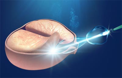 Laser Enukleation der Prostata
